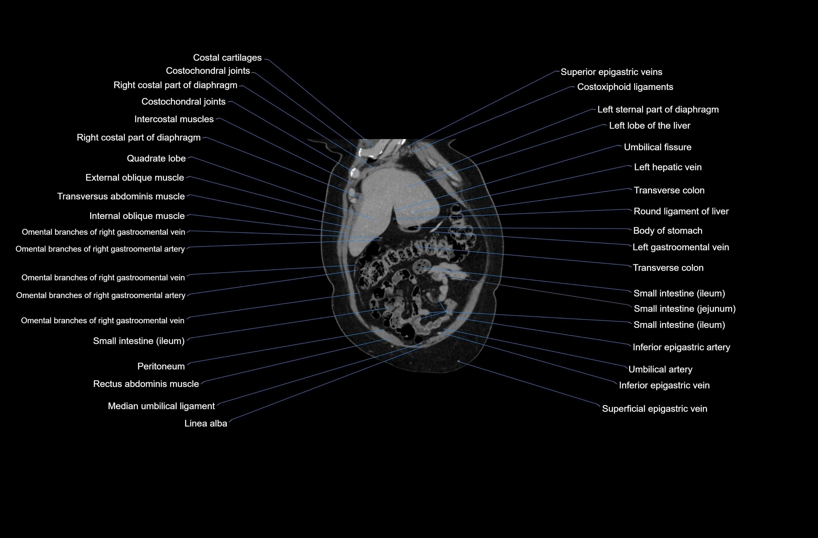 CT abdomen coronal cross sectional anatomy labelled radiology image-00015.webp